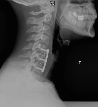 cervical x-ray #1